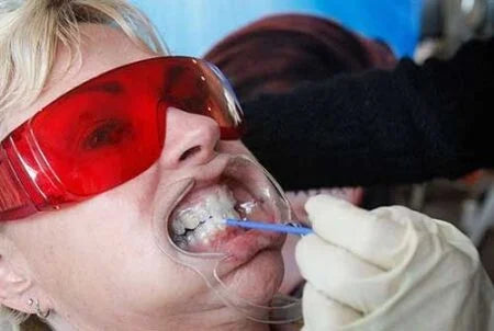 Mondspreider – Maat Meduim